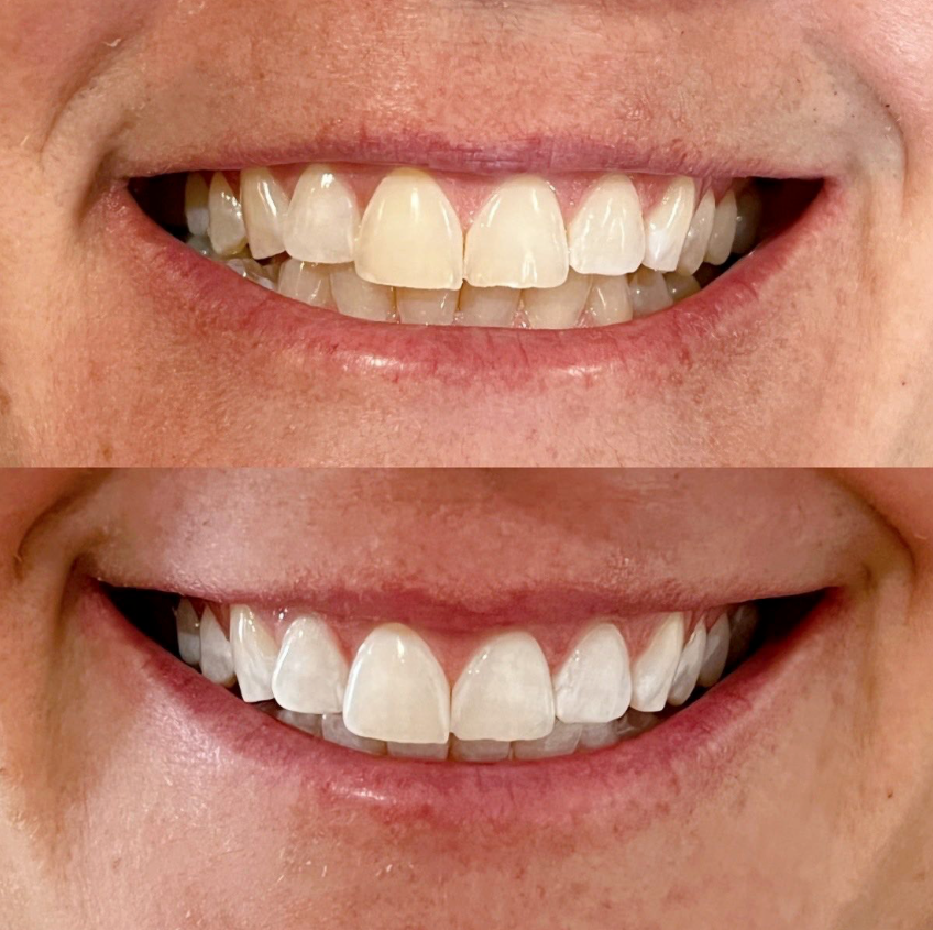 Is Teeth Whitening For Me?